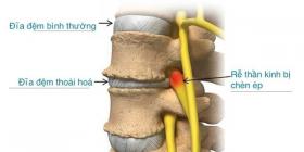 Cách chữa thoái hóa đĩa đệm cột sống