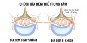 Chệch đĩa đệm nguyên nhân và cách chữa