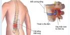 Hẹp đĩa đệm: Nguyên nhân, triệu chứng và hướng điều trị
