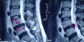 Nguyên nhân cách chữa trượt đốt sống thế nào mới đúng 